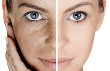 microneedling_before_after